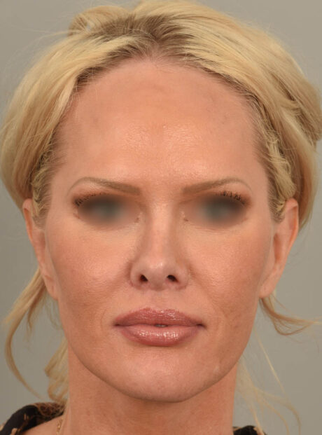 Lip Lift case #11737