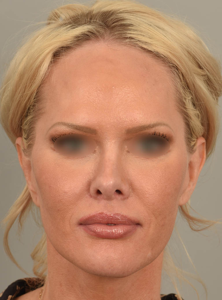 Lip Lift case #11737