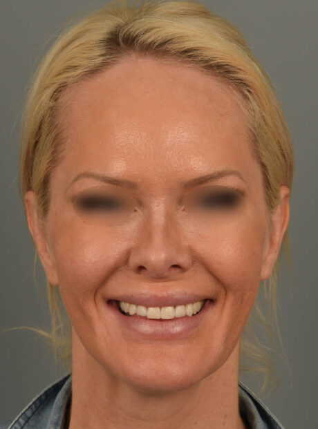 Lip Lift case #11737