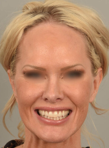 Lip Lift case #11737