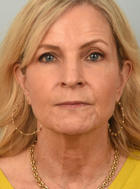 Facelift case #11468
