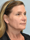Facelift case #11819