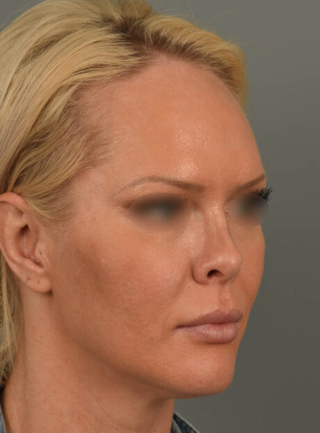 Lip Lift case #11737