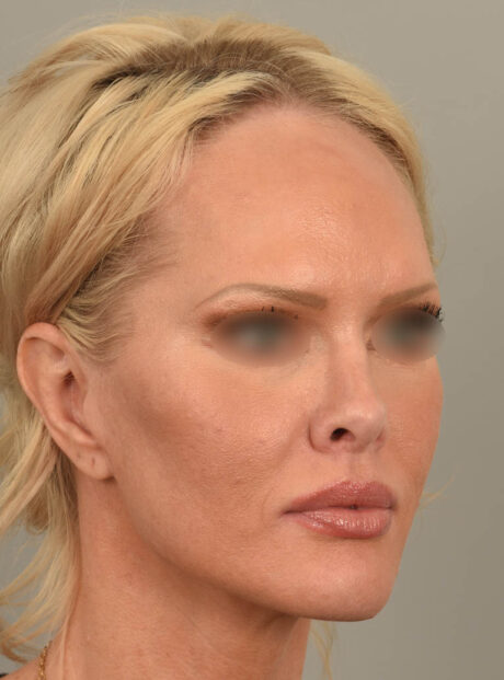 Lip Lift case #11737