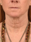 Facelift case #11448