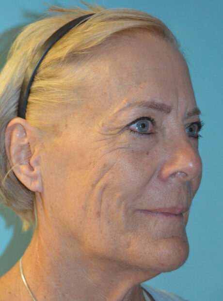 Eyelid Surgery case #11824