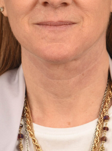 Facelift case #11448