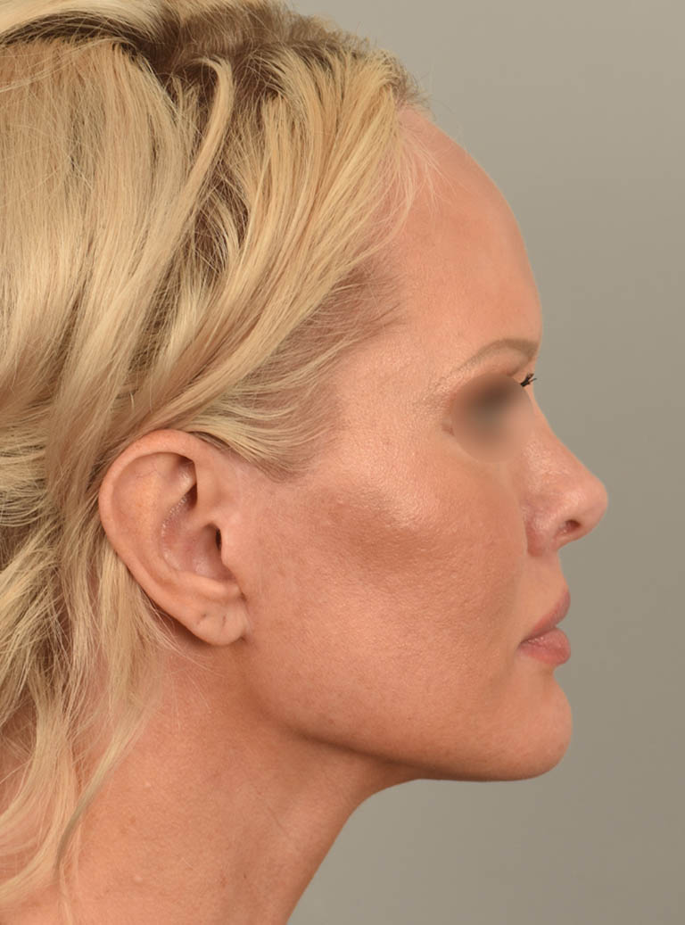 Lip Lift case #11737