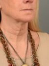 Facelift case #11448