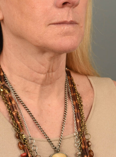Facelift case #11448