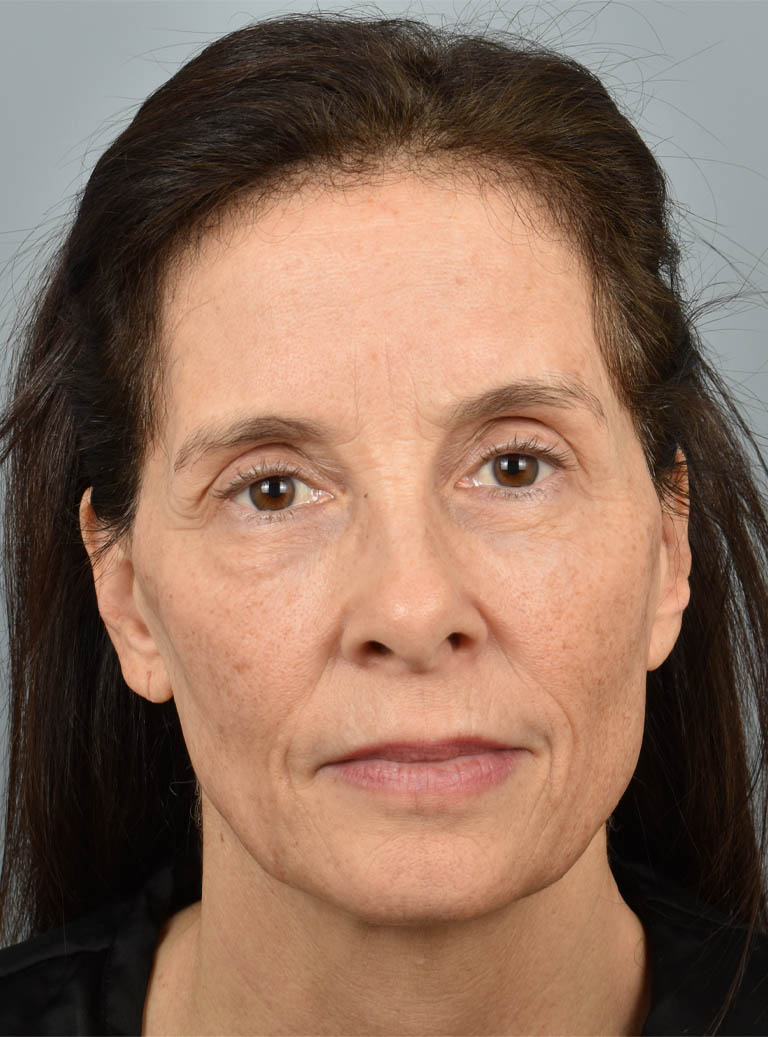 Eyelid Surgery case #11827