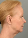 Lip Lift case #11730