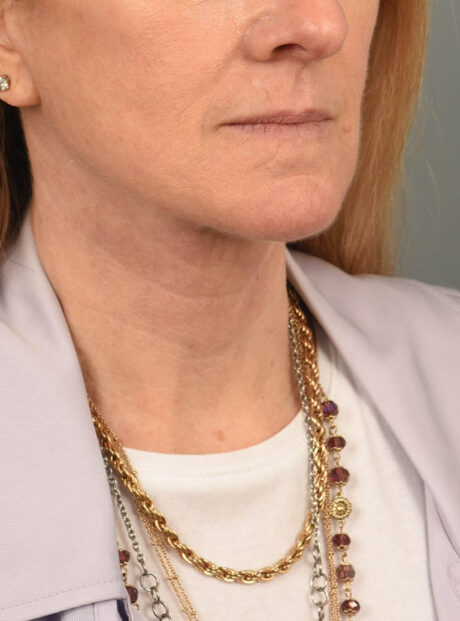 Facelift case #11448