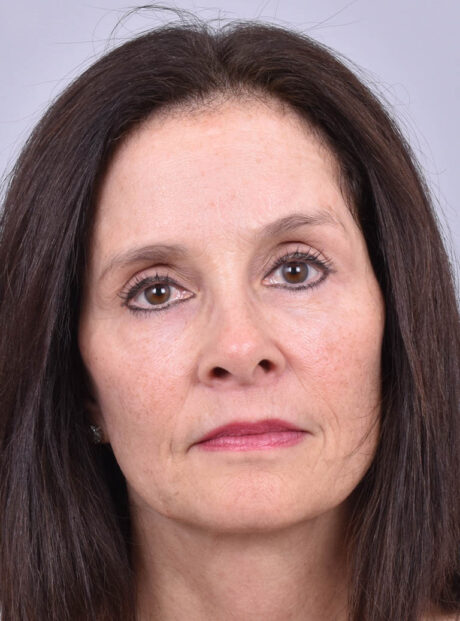Eyelid Surgery case #11827