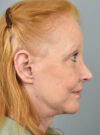 Lip Lift case #11730