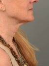 Facelift case #11448