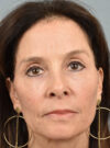 Eyelid Surgery case #11827