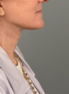 Facelift case #11448