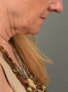Facelift case #11448