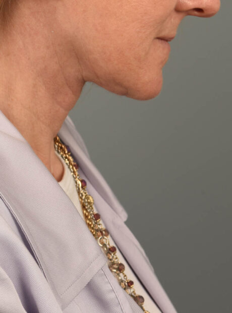 Facelift case #11448