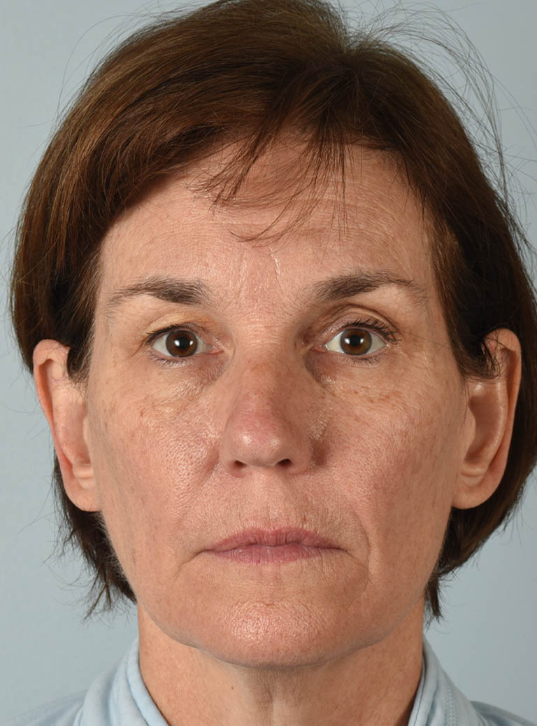 Eyelid Surgery case #11423