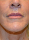 Facelift case #11832