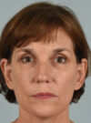 Eyelid Surgery case #11423