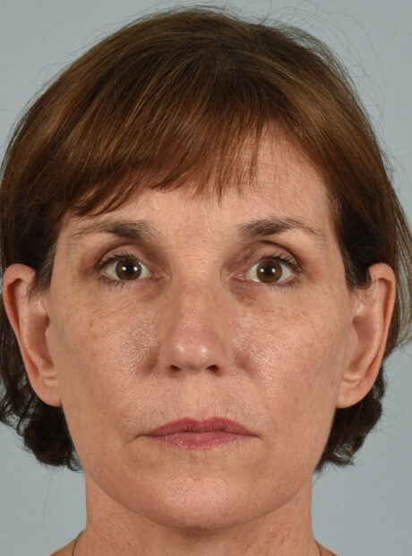 Eyelid Surgery case #11423