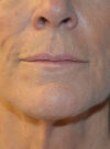 Facelift case #11832