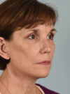 Eyelid Surgery case #11423