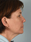 Eyelid Surgery case #11423