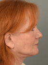 Lip Lift case #11723