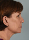 Eyelid Surgery case #11423
