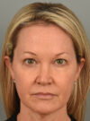 Eyelid Surgery case #11567