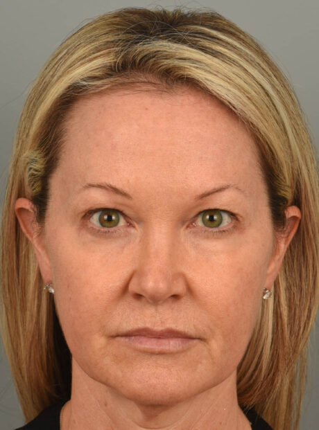 Eyelid Surgery case #11567