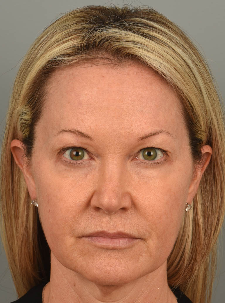 Eyelid Surgery case #11567