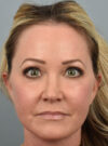 Eyelid Surgery case #11567
