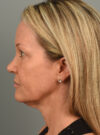 Eyelid Surgery case #11567
