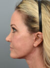Eyelid Surgery case #11567
