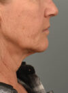 Facelift case #11379