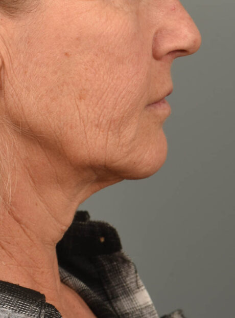 Facelift case #11379