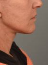 Facelift case #11379
