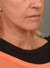 Facelift case #11379