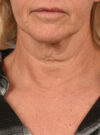 Facelift case #11379