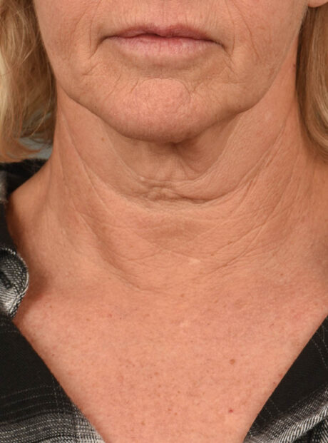Facelift case #11379