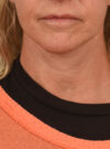 Facelift case #11379