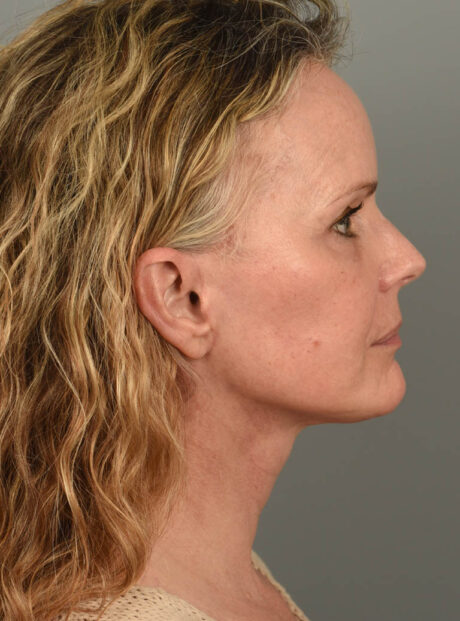 Facelift case #11457