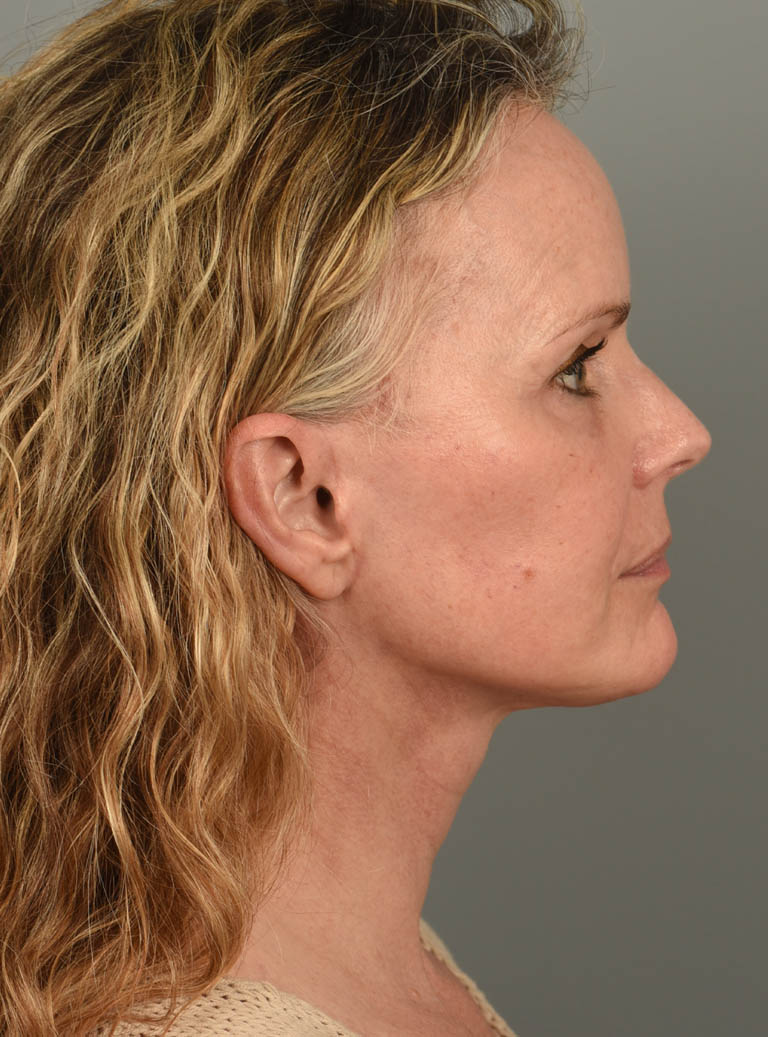 Facelift case #11457