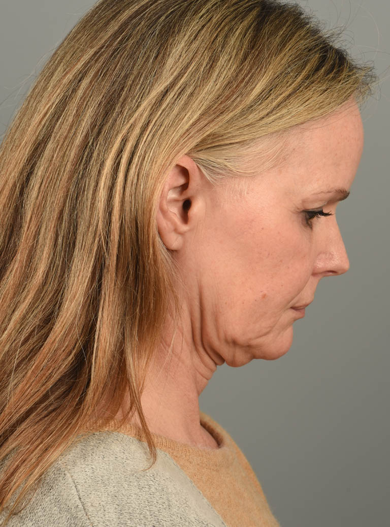 Facelift case #11457