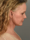 Facelift case #11457